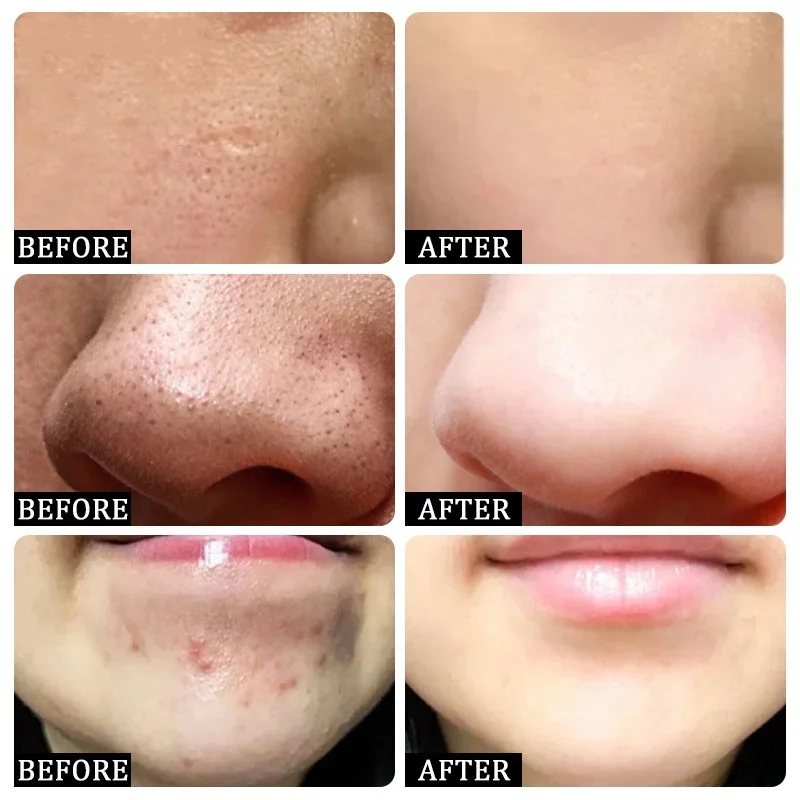 حمض الساليسيليك كريم إزالة الم - مراجعة Collagen Peptide Powder وسعره