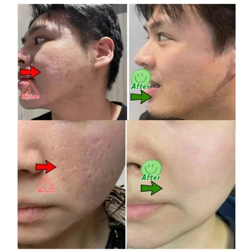 حمض الساليسيليك كريم إزالة الم - مراجعة Collagen Peptide Powder وسعره